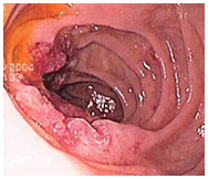 Cost Gastric- Duodenal Stomach Cancer Treatment Hospital India