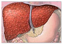 Liver Cirrhosis offers info on Liver Cirrhosis Treatment India, Liver Cirrhosis   India, Liver Cirrhosis Treatment   India