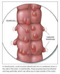 Diverticulosis - Cancer Treatment  India offers info on Cost Diverticulosis - Cancer Treatment India
