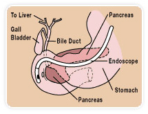 Endoscopic Retrograde Cholangiopancreatography offers info on ERCP India, Endoscopy India, Retrograde India