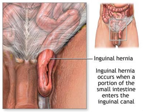 Hernia Repair Surgery   India, Hernia India, Hernia Repair Treatment India