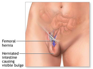 Hernia Repair Surgery offers info on Hernia Repair India, Hernia Repair Surgery   India, Hernia Repair Treatment India