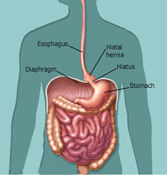 Gastric Hiatus Hernia Surgery offers info on Gastric India, Hiatus Hernia India