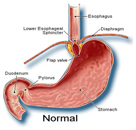 Gastric Hiatus Hernia Surgery offers info on Gastric India, Hiatus Hernia India