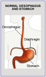 Hiatal Hernia India, Stomach India, Hernias India, Gastric Hiatus Hernia Surgery   India