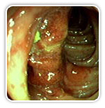 Inflammatory Bowel Disease offers info on Inflammatory Bowel Disease Treatment   India, IBD India, Intestinal Bacteria May Offer Inflammatory Bowel Disease Treatment India