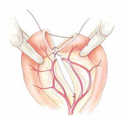 Intestinal Resection Surgery offers info on Intestinal Resection India, Intestinal India, Resection India, Intestinal Resection Surgery   India