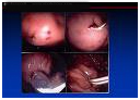 Pseudo Pancreatic Cyst Treatment offers info on Pancreatic Cysts India, Cysts India, Pancreas India, Pseudo Cyst Treatment India