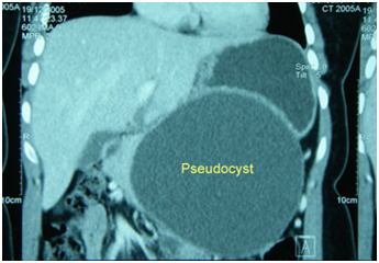 Pseudo Pancreatic Cyst Treatment offers info on Pancreatic Cysts India, Pancreas India, Pseudo Pancreatic Cyst India