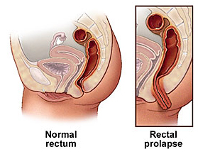 Prolapsed Colon Symptoms