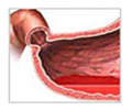 Ulcers Treatment  India, Gastric Ulcers Treatment  India, Cost Duodenal Ulcers Treatment India