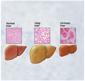 Liver Surgery offers info on Liver Surgery   India, Liver India, Liver Disease India, Liver Transplant India