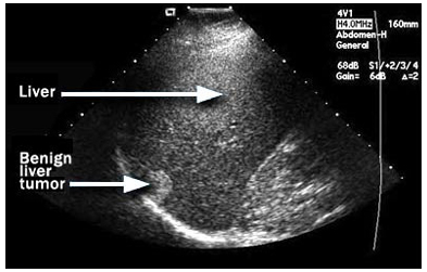 Liver Transplant   India, Liver Cancer India, Liver Resection India, Liver Treatment India