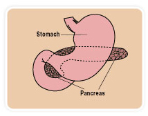 Pancreatic India, Laparoscopic Pancreatic Surgery India, Pancreatic Diseases India, Pancreatitis India