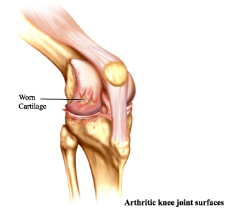 High Flex TKR, Flexible, High Flex, High Flex Knee Replacement Surgery India