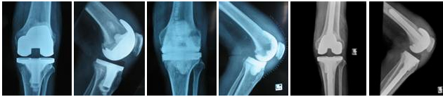Knee Replacement Surgeon, Knee Pain, Total Knee Replacement Surgery Risks