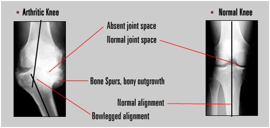 Knee Pain, Knee Disability, Knee Replacement Surgery