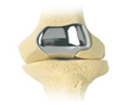 Knee Replacement Implant, Knee Joint Replacement Overseas