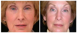 wrinkle removal, removal wrinkle, wrinkle causes, causes wrinkle, wrinkle treatment, wrinkle treatment India, treatment wrinkle, India wrinkle treatments, wrinkle treatment hospitals India, wrinkle removal surgery India , wrinkle removal treatment India, wrinkle prevention, India