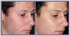 Laser Surgery India Acne Removal offers info on Cost Acne Removal Laser Surgery India, Laser Therapy Reduces Facial Acne India