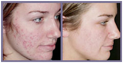 Laser Surgery India Acne Removal offers info on Cost Acne Removal Laser Surgery India, Laser Hair Removal India