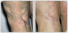 Low Cost Leg Skin Veins Surgery Delhi India, Leg Skin Veins Surgery Mumbai Hospital India