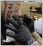 Tattoo Removal Laser Surgery India,India Tattoo Removal Surgeons India