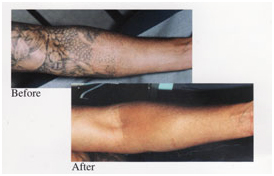 Tattoo Removal Surgery India offers info on Cost Laser Tattoo Removal ...