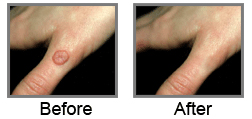 Tattoo Removal Zagreb - Hand wart-treatment-info.com