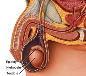 Hydrocele India, Hydrocele Surgery offers info on Hydrocele Operation India, Adult India, Adult Onset Hydrocele India
