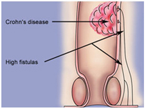 Anal Fistula Surgeons India, Piles India, Hemorrhoids India, Fissure India, Fistula India