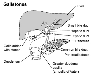 Cholecystectomy Surgery offers info on Cholecystectomy India, Cholecystectomy Surgery India