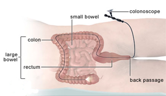 Colonoscopy Surgery India, Low Cost Colonoscopy Surgery Delhi India, Colonoscopy Surgery In India