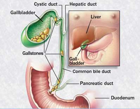 Gallstones Surgery offers info on Gallstones India, Gallstones Surgery India, Gallstone India, Gall Bladder Surgery India