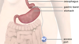 Gastric Banding India, Advanced Adjustable Gastric Band India, Gastric Banding Surgery India Gastric Banding Surgery Recovery India