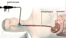 Gastroscopy India, Gastroscopy Operation India, India Hospital Tour India