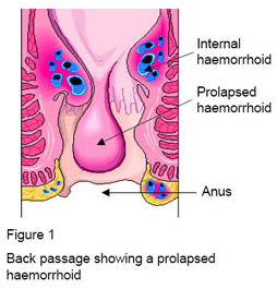 Hemorrhoidectomy Surgery offers info on Excision India, Hemorrhoidectomy India, Hemorrhoid Surgery India