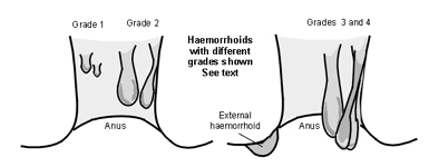 Hemorrhoid Surgery India, Hemorrhoid Treatment India, Hemorrhoidectomy Treatment India, Hemorrhoids India