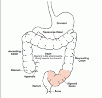 Hemicolectomy Right Surgery offers info on Right Hemicolectomy India, Hemi Colectomy Right Surgical Procedures India, India Hospital Tour India