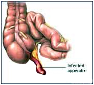 Laparoscopic Appendectomy Surgery India offers info on Cost Appendectomy Hospital India, Laparoscopic Abdominal Surgery India