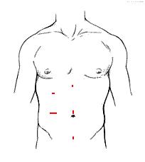 Laparoscopic Colectomy Surgery India offers info on Cost Colectomy Surgery Hospital India, Colon Surgery India, Bowel Cancer India