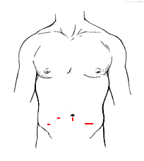 Laparoscopic Colectomy Surgery India offers info on Cost Colectomy Surgery Hospital India, Colon Cancer India, Bowel Cancer India