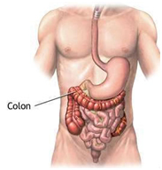 What is a colectomy surgery?