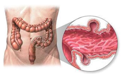 Colon Surgery India, Cancer Of The Bowel India, Bowel Cancer India