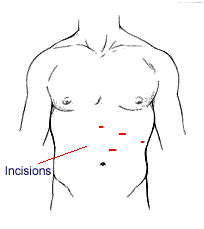 Laparoscopic Abdominal Surgery Gurgaon India, Laparoscopic Abdominal Surgery India