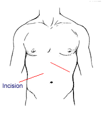 Laparoscopic Abdominal Surgery offers info on Laparoscopic Surgery Training India, Laparoscopic Abdominal Surgery India