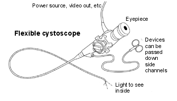 Best Cysto-Diathermy Surgery Surgeon India Offers info on Cysto-Diathermy Surgery India