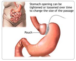 Gastric Banding India, Advanced Adjustable Gastric Band India, Gastric Banding Surgery India