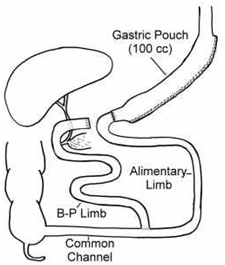 Duodenal Switch Surgery offers info on Duodenal Switch India, Duodenal Switch Surgery India, Duodenal Switch Procedure India