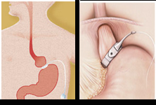 Laparoscopic Banding India, Advance Laparoscopic Surgery India, Risks Of Laparoscopic Banding Surgery India